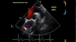 Subcostal Views  Transthoracic Echocardiogram TTE [upl. by Aisatnaf112]