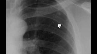 Chest xray  Histoplasmosis [upl. by Hermina442]