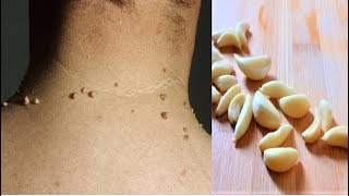 Remove Skin Tags  Home Remedies To Remove Skin Tags Easily [upl. by Thun]