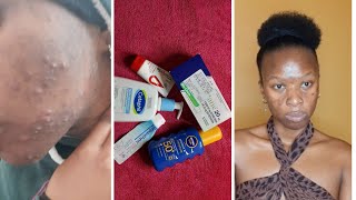 Oratane 3months Review Clearing my Acne Athayabulela  South African YouTuber acnetreatment [upl. by Mccowyn]