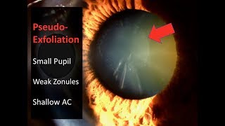 PesudoExfoliation Cataract Surgery Technique including Pupil Stretching [upl. by Oswin]