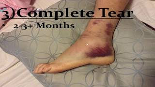 Sprained Ankle Ligaments Best Home Treatment [upl. by Ebbie307]