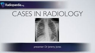 Cases in Radiology Episode 3 pediatric chest xray [upl. by Peh724]