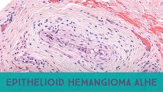 Epithelioid hemangiomaangiolymphoid hyperplasia w eosinophilia Australasian Dermpath 2022 Case 8 [upl. by Alex899]