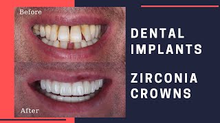 Dental Implants amp Zirconia Crowns Patient Review [upl. by Ainit]