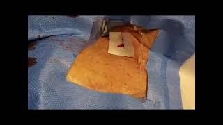 BloodSTOP iX  Pull of 9 French Sheath controls bleeding in minute [upl. by Ennael88]