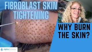 PLASMA FIBROBLAST SKIN TIGHTENING  WHY BURN THE SKIN [upl. by Shieh190]