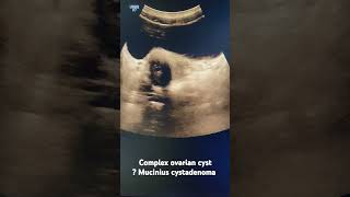 Ovarian cyst mucinous cystadenoma  ultrasonography radiology gynaecology [upl. by Bate]