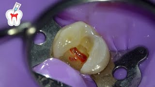 Live Premolar Root Canal Procedure [upl. by Nnaecarg]