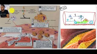 lipoprotein part 4  Atherosclerosis LPa [upl. by Carce]