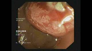 Pancreatic Duct PD Dilatation [upl. by Romain]