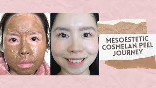 Cosmelan Treatment by Mesoestetic  Removal of Freckles Melasma amp Pigmentation [upl. by Bohi]