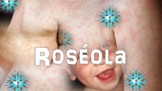 Virus Herpes Humano 6 Y 7Roseola [upl. by Koehler]