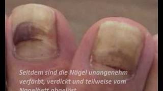 Nagelpilz Folgen sind gelbe dicke Fußnägel Was tun Das spezielle Fußnagel Spray [upl. by Thun540]