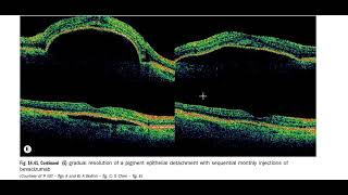 Kanski Clinical Ophthalmology Made Easy  Macula 5 B [upl. by Atalante]