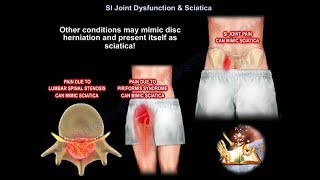 SI Joint Dysfunction amp Sciatica  which one is causing the pain  how do we treat it [upl. by Adnolahs]