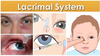 Lacrimal System 2 Major Topic Congenital and Acquired Nasolacrimal Duct Obstruction [upl. by Itsyrc471]