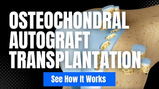 Osteochondral Autograft Transplantation  3D Animation Mosaicplasty  OAT [upl. by Einnaffit]