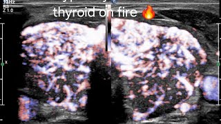 How to Differentiate Hashimotos Thyroiditis vs Hyperthyroidism on Ultrasound amp Doppler ultrasound [upl. by Hamo]