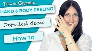 Hand and Body Peeling  Tutorial  Demonstration  TCA 30 versus Glycolic 70 [upl. by Voccola]