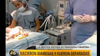 Lograron separar a siamesas  Telefe Noticias [upl. by Eesdnyl]