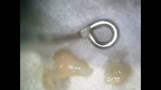 Tonsil Stone Tuesday  July 23 video [upl. by Knepper]