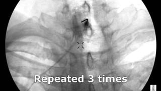 Cervical Interlaminar Epidural Steroid Injection  ThePainSourcecom [upl. by Nolahs793]