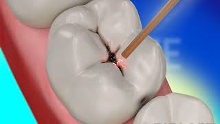 Dental Restoration with Waterlase Laser Dentistry  BIOLASE [upl. by Breanne]