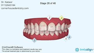 Posterior crossbite Narrow arches Asymmetric arches Mandibular midline deviation Midline shift [upl. by Cynthea121]