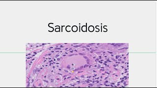 Sarcoidosis  Morphology Pathogenesis [upl. by Aleka488]