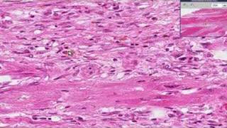 Histopathology Heart Myocardial infarction recent [upl. by Acie556]