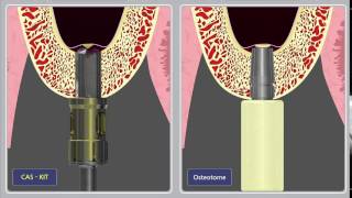 CAS vs Osteotome [upl. by Thierry]