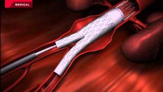 CARDIOLOGIA  ZENITH  ANEURISMA AÓRTICA ABDOMINAL AAA  COOK [upl. by Ticon799]