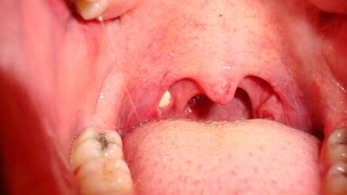 Tonsil Stones  How to Remove Tonsil Stones [upl. by Dibbrun482]