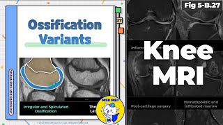 Fig 5B27 Types of Ossification Variants of the Knee [upl. by Odnumyer]