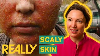 Dr Emma Treats Woman With Scaly Skin Disease  The Bad Skin Clinic [upl. by Charters]