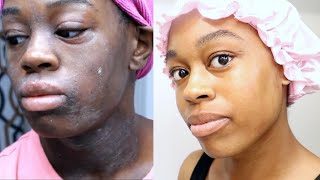 Eczema Treatment Journey  This Skincare Routine Changed My Life  DeSade [upl. by Elvis]