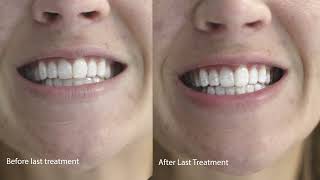 Lumineux Teeth Whitening Strips 21 Treatments Enamel Safe  Whitening Without The Sensitivity [upl. by Mit]