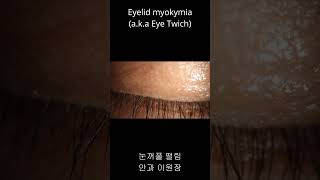 눈꺼풀이 파르르 떨려요 눈떨림 눈꺼풀 떨림 Eyelid myokymia Eye twitch shorts [upl. by Dodson]