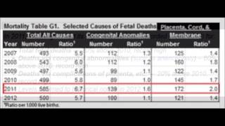 FUKUSHIMA 原発 放射能☢胎児死先天的異常死急増で最悪2011☢USA 保健省BirthDefectDeathHighRecord❢ [upl. by Aer5]