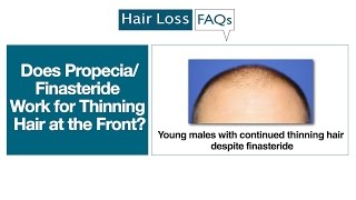 Does PropeciaFinasteride Work for Thinning Hair at the Front [upl. by Adnauqal]