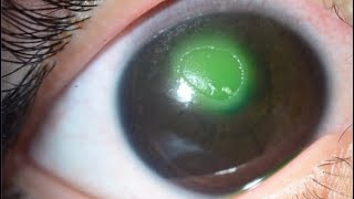 NEUROTROPHIC CORNEAL ULCER [upl. by Bonnibelle]