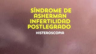 Síndrome de Asherman  Infertilidad Post legrado Histeroscopia [upl. by Laina]