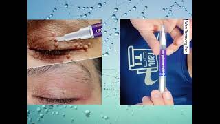 Jaysuing Wart Removal Liquid Pen Skin Tag Removal Liquid Wart Removal Cream [upl. by Mayfield]