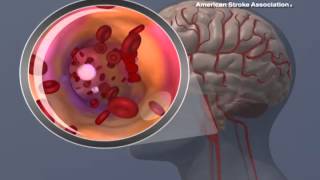 Ischemic Stroke Animation [upl. by Annam7]