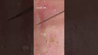 Pickel Ausdrücken Spa  Blackheads Akne amp Mitesser entfernen 🔴 79 [upl. by Radie310]