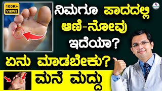 Foot Pain CornCallosity  Home Remedies ಪಾದದಲ್ಲಿ ಆಣಿ  ನೋವು ಇದೆಯಾ ಏನು ಮಾಡಬೇಕು ಮನೆ ಮದ್ದು [upl. by Cristobal]