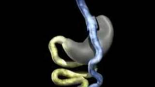 Laparoscopic Rouxeny Gastric Bypass by Marc Zare MD [upl. by Rutter]