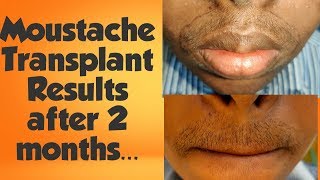 Moustache Transplant  First 3 months update  Shedding to Growth phase  DrSreenath  Kochi [upl. by Laira]