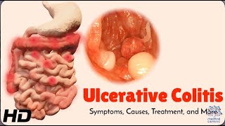 Ulcerative Colitis Explained Symptoms Causes and Treatment Options [upl. by Sturrock]